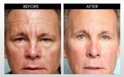 face rolling before and after|dermarolling before after collagen.